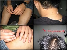 Akupunktur Sakit Tangan, Kaki, Lutut, Kepala
