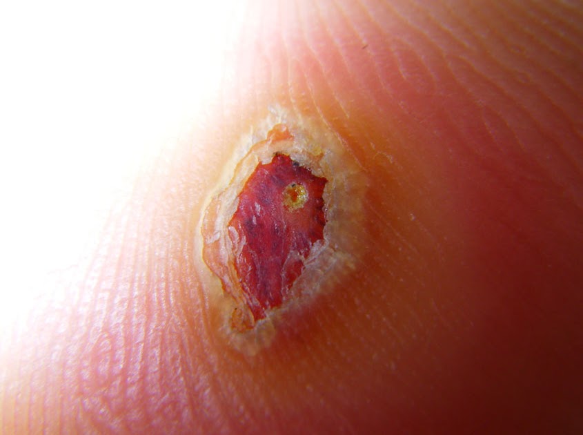 Images of Plantar Warts and Apple Vinegar Day 15