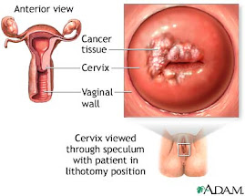 CANCER CERVICAL