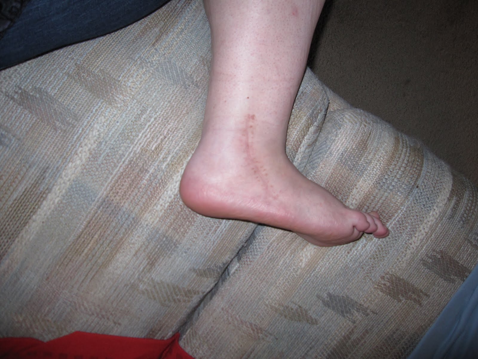Peroneal Tendon Swelling
