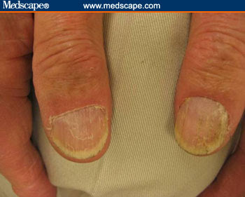 Nail Illness