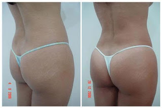 cirugia aumento de gluteos lipoinyeccion