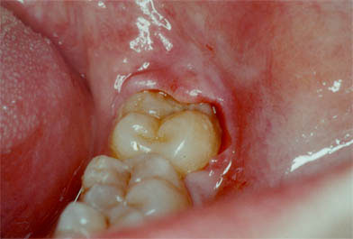 Resultado de imagen de pericoronaritis dental