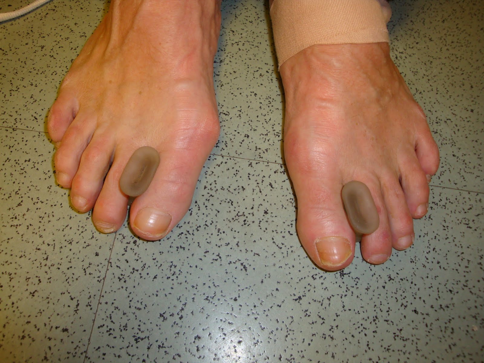 bunion bunions foot pain bottom problems bone ankle right bump walking causes hip shoe ache dr flexor common blake richard