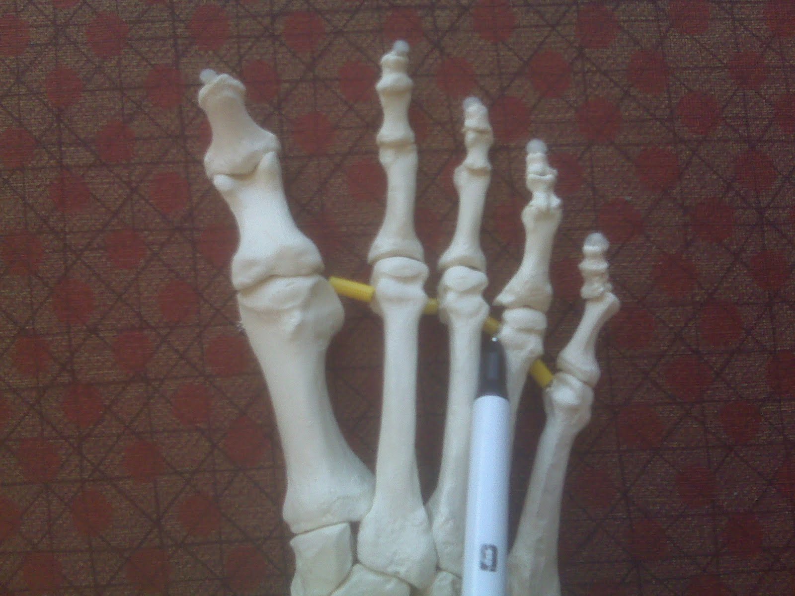 Foot and Ankle Problems By Dr. Richard Blake Morton's Neuromas Which