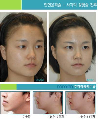 Korean Plastic Surgery Clinic on Korean Plastic Surgery Clinic Romian   Korean Plastic Surgery  Jaw