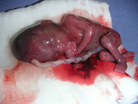Como funciona o aborto induzido Como funciona o aborto induzido