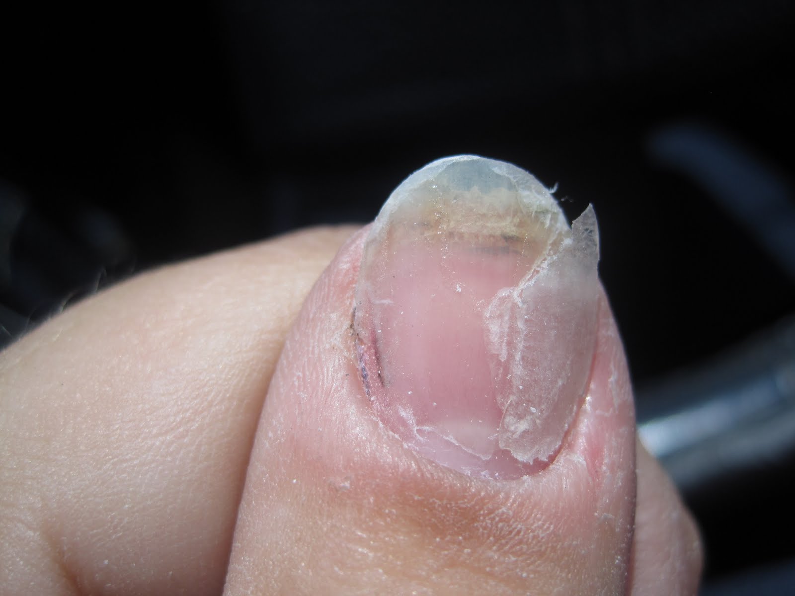 Bruised Thumb Nail