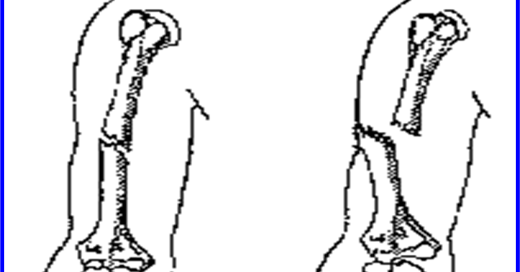 kesehatan Pengertian Fraktur