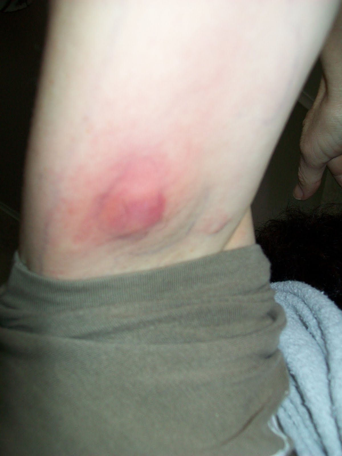 spider bite nz
