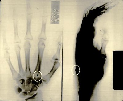 [UFO_alienimplant2.jpg]