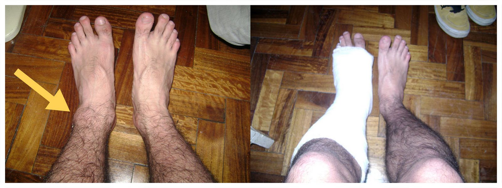 [twisted+ankle+sprain+tobillo+torcido+yeso+plaster+platered+lesion+injury+enyesado.jpg]