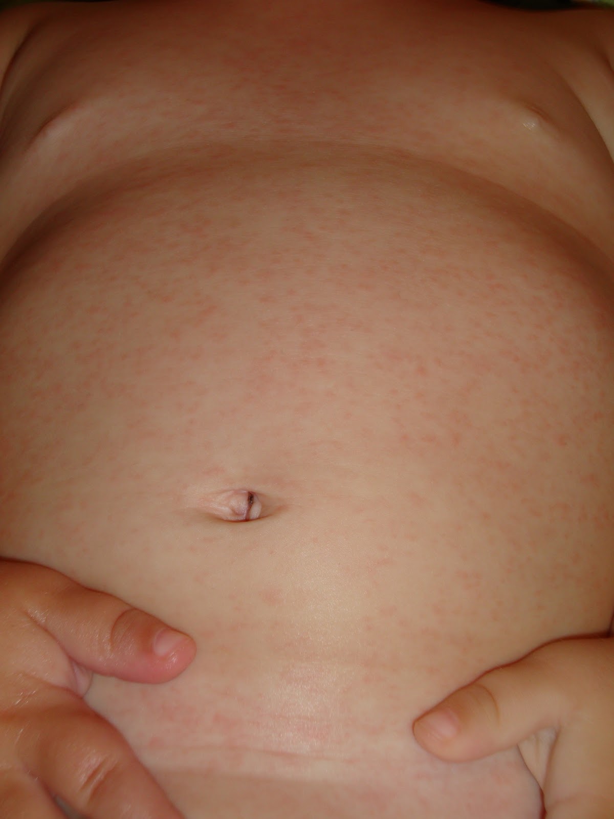 reaction to vaccine vaccine reaction rash images reaction to vaccine vaccine reaction rash images