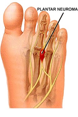 The bottom foot nerve damage white