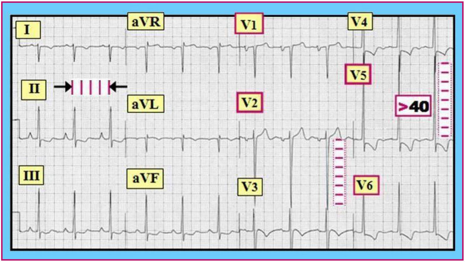 ekg reading