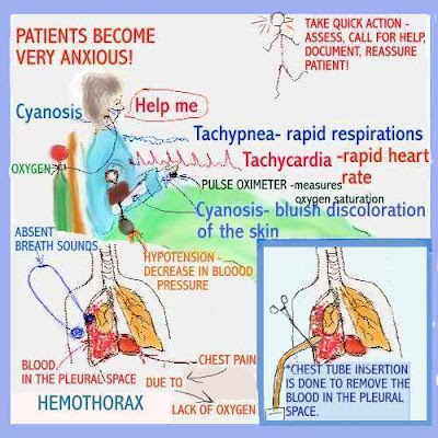 What Is Pneumothorax