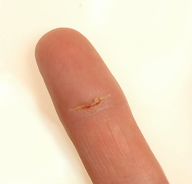 Wrist Spin Bowling Injury of the month update Mar 31st