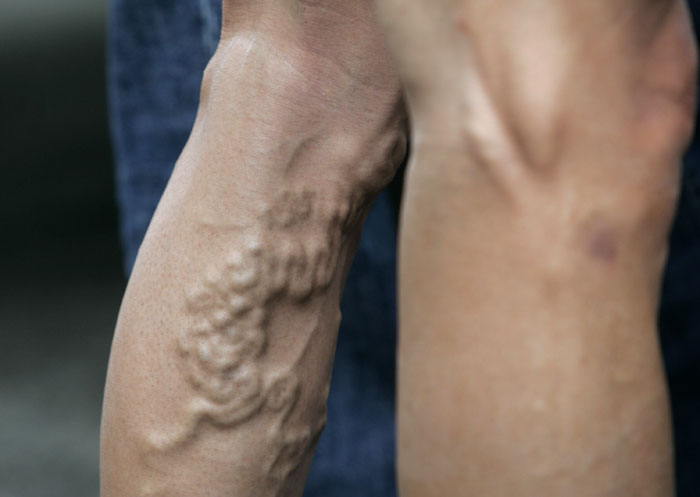 DOLOR PIERNA VARIZ dolor pierna variz:
