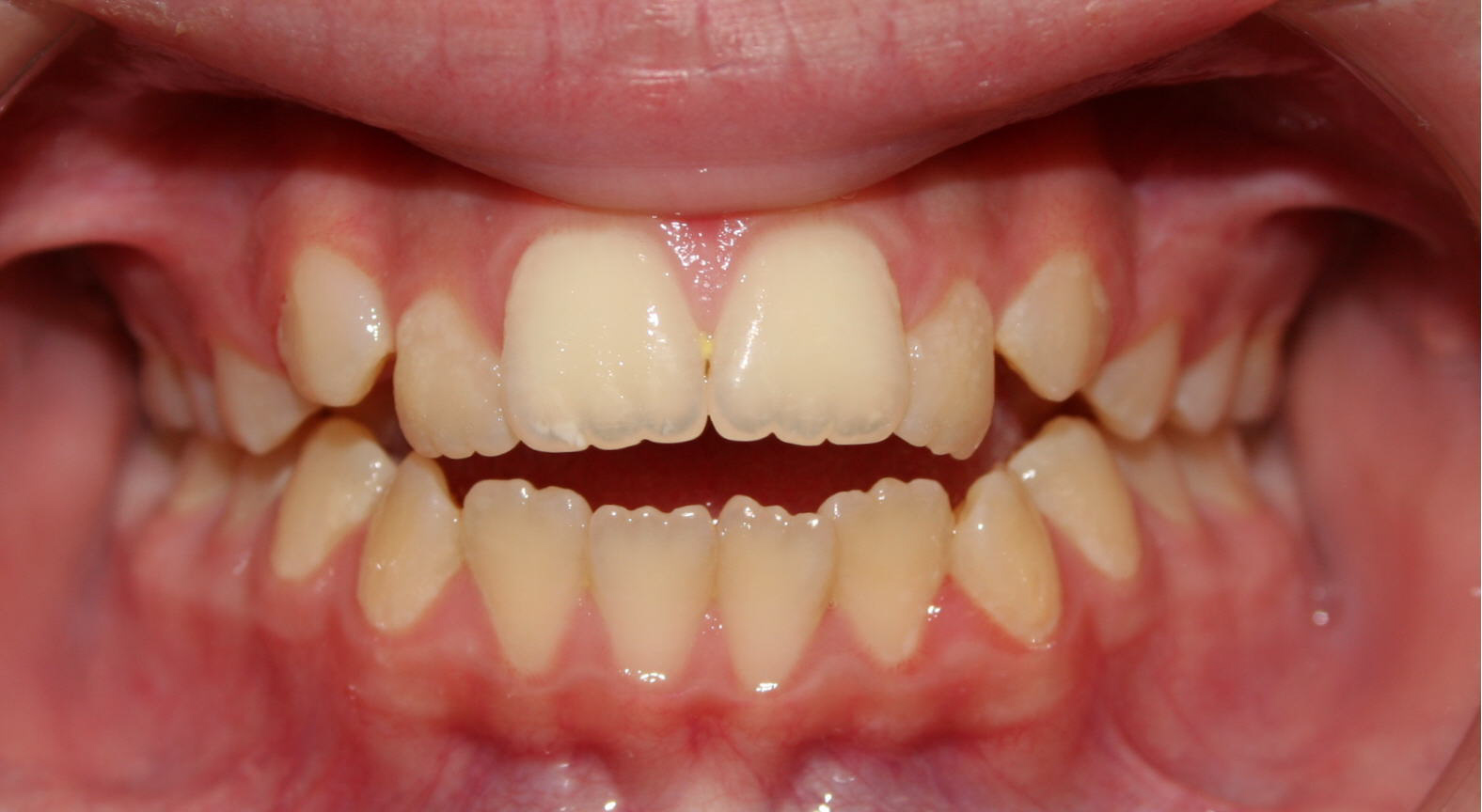 Orthodontics by Dr. Tom Blase Open bites easy to find but hard to fix!