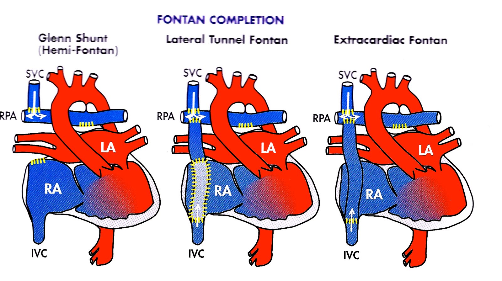univentricular heart single ventricle syndromes heart glenn procedure