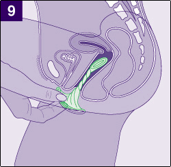 How to use female condom