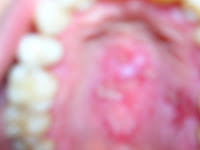 lupus mouth sores