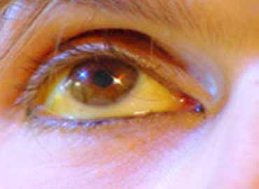 Fotografia thrombophlebitis su mani