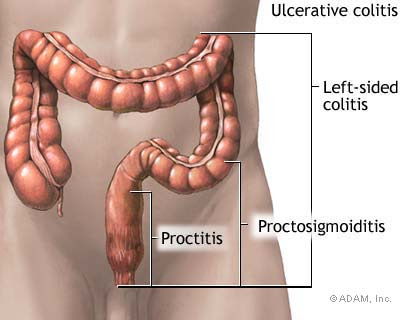 Rectal Sores