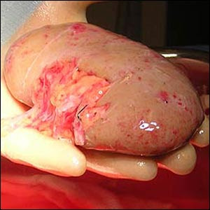 Kidney Stones Symptoms Picture