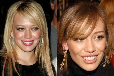 Pictures Of Before And After Veneers. Hilary Duff Before And After