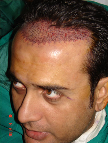 SHAHOOD ALVI (BEFORE SURGERY)