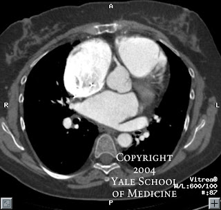 axial ct scan chest