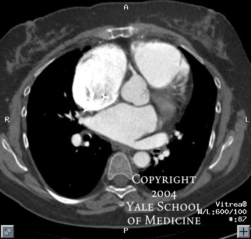 axial ct chest