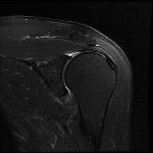 Radiology Cases Adhesive Capsulitis