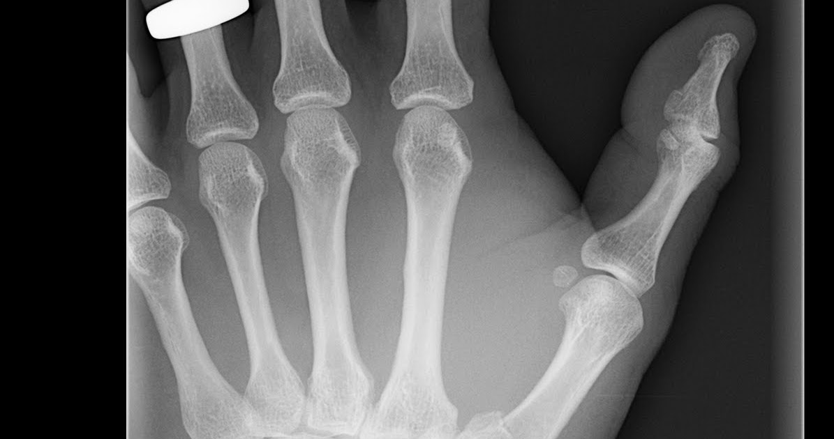 Radiology Cases Fracture
