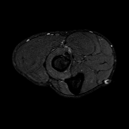 Radiology Cases PIN Syndrome