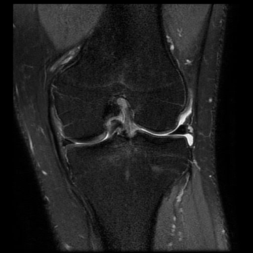 Radiology Cases Bucket Handle Tear