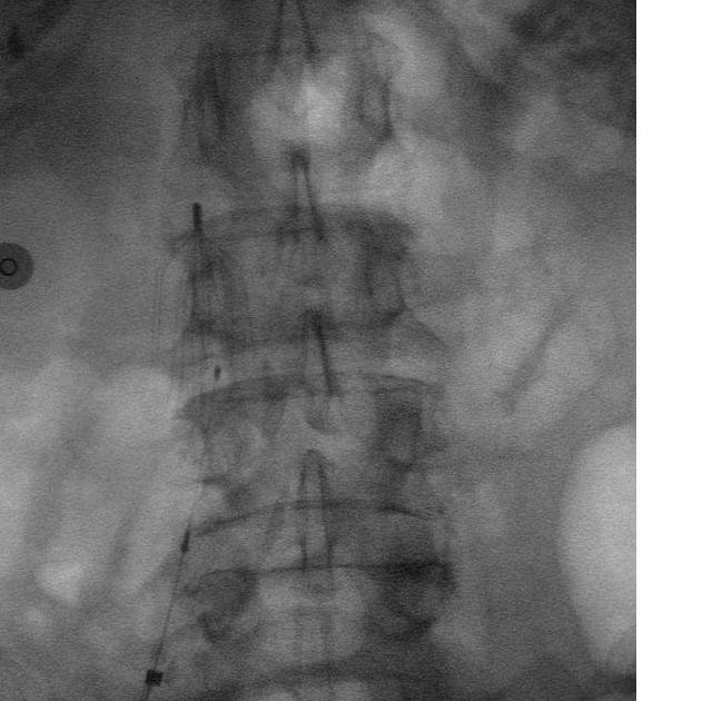 Radiology Cases IVC Filter