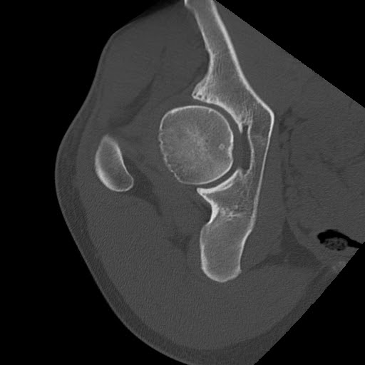 Radiology Cases CAM Type FAI