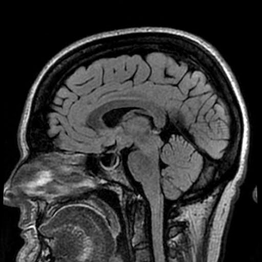 Radiology Cases Idiopathic Intracranial Hyertension