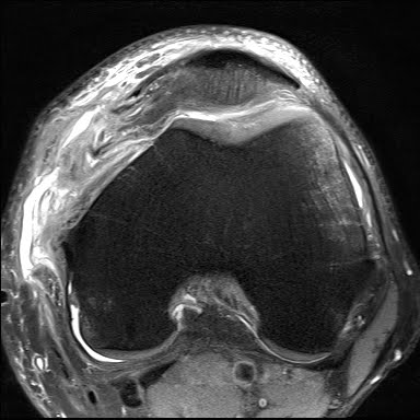 Radiology Cases: Transient Patella Disclocation