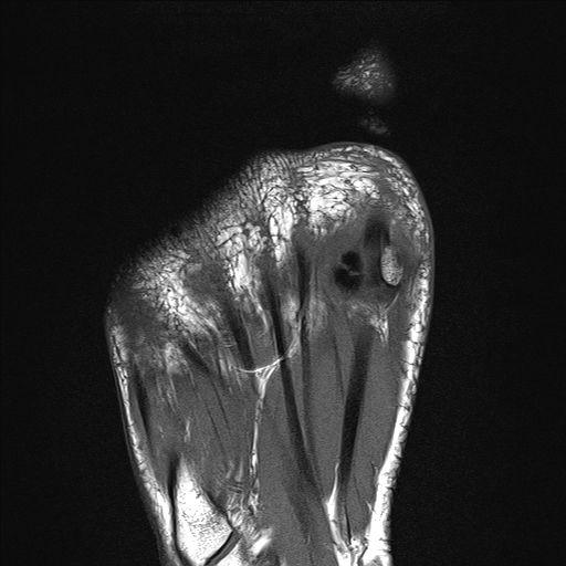 Radiology Cases Osteochondritis / AVN of Bipartite Lateral Sesamoid
