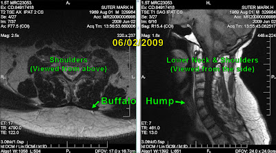 Buffalo Hump Treatment