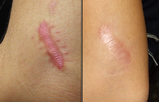 Keloid scars before and after, scars be gone review