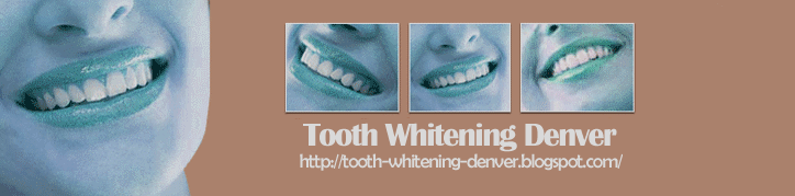 Tooth Whitening Denver
