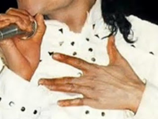 Vitiligo e Lúpus... o que, quando e por que?  MJ+vitiligo+2