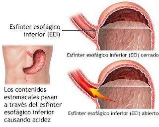 acidez de estómago