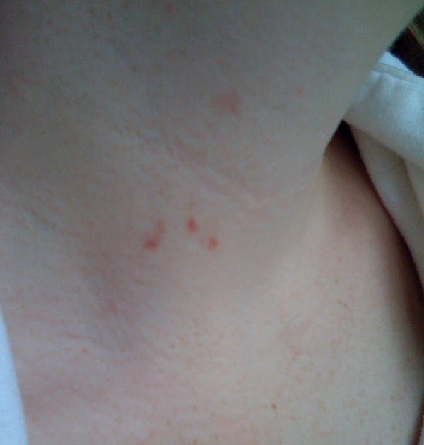 Neck hickey like rash on Is This