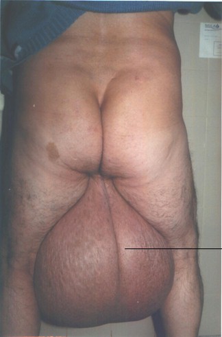 elefantiasis_testicular_escroto_2%255B1%255D.jpg