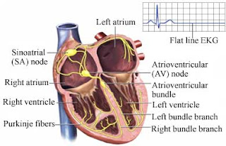 Cardiac Arrest